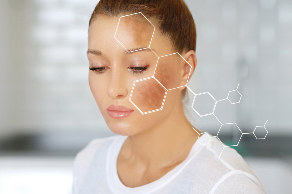 Understanding Skin Hyperpigmentation and Molecular Care A woman looking downward with hyperpigmentation on her forehead and cheek, highlighted by white hexagonal molecular structures overlaid on the skin.